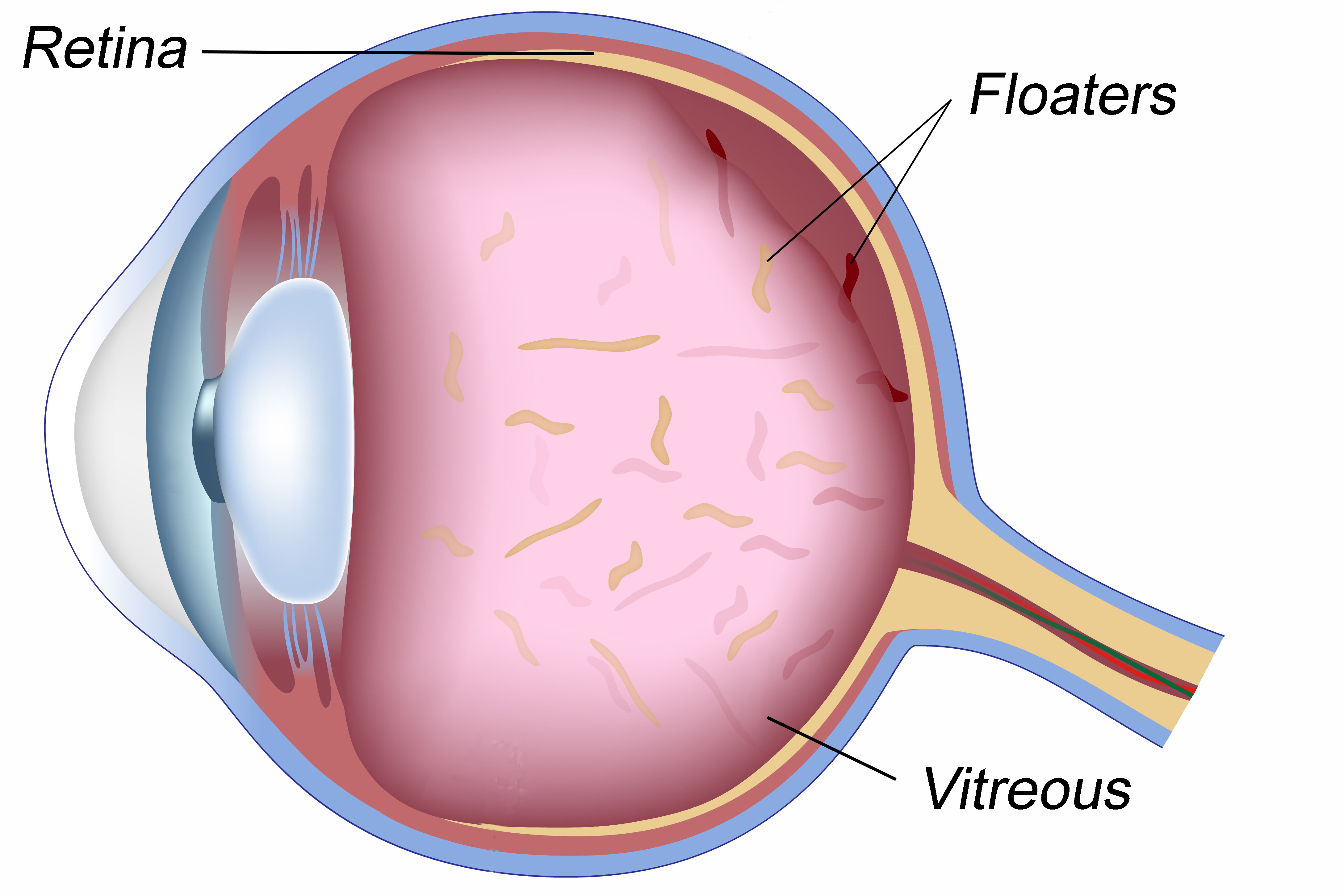 vitreous syneresis treatment