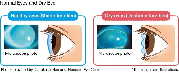 Normal eyes vs dry eyes